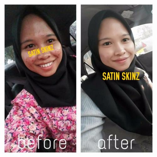 satin skinz testimoni glutathione vitamin c