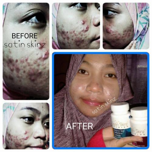 satin skinz testimoni jerawat
