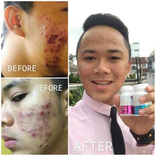 satin skinz testimoni jerawat