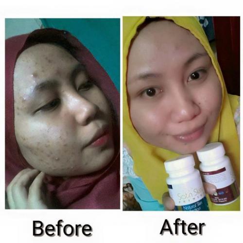 satin skinz testimoni jerawat