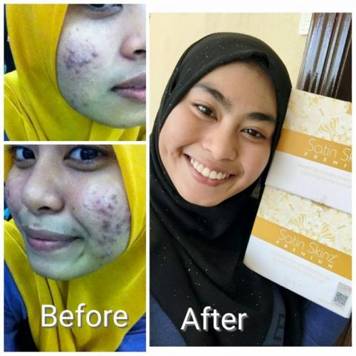 satin skinz testimoni jerawat