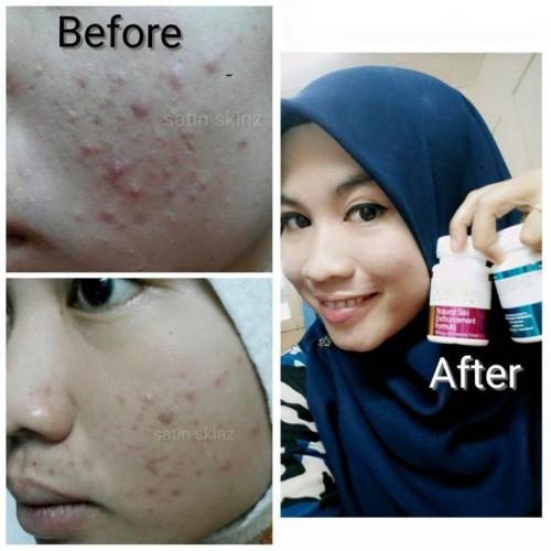 satin skinz testimoni jerawat